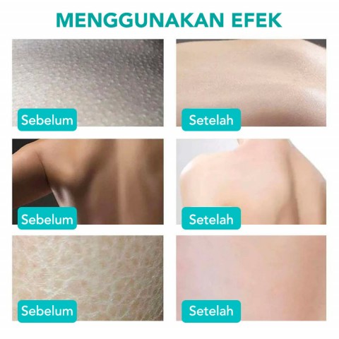 Cream untuk bokong gelap, ketiak gelap, selangkangan gelap, jerawat punggung, lutut gelap, siku gelap, memudarkan flek hitam