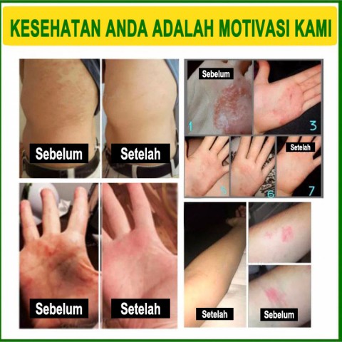 100% Asli Jepang Herbal Anti-gatal Antibakteri Miracle Cream