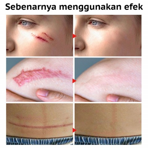 Scar Remover Gel Cream Perawatan Jerawat Whitening Moisturizer Serum Perawatan Kulit