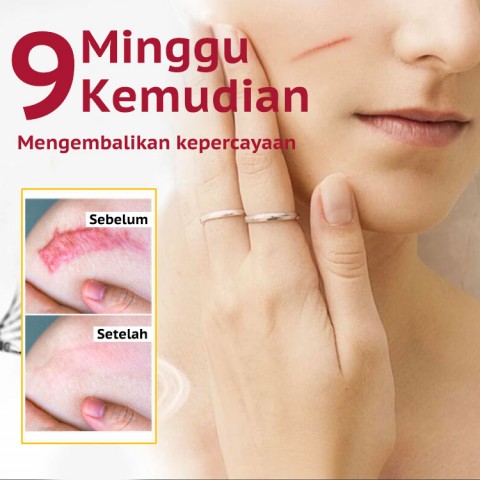 Scar Remover Gel Cream Perawatan Jerawat Whitening Moisturizer Serum Perawatan Kulit