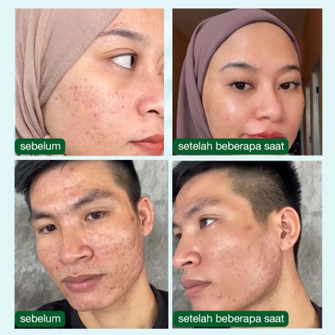 Serum Wajah Asam Azelaic