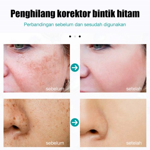 Krim Serum Anti Bintik Hitam