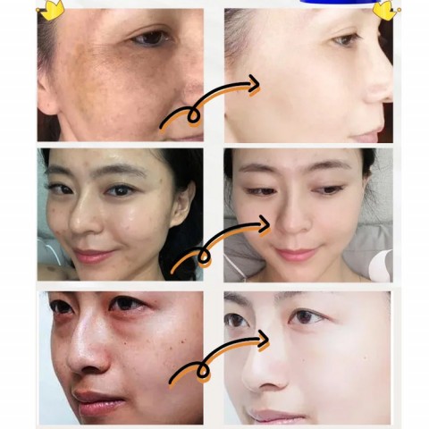 Krim Pemutih dan Anti-Flek Hitam Vitamin E