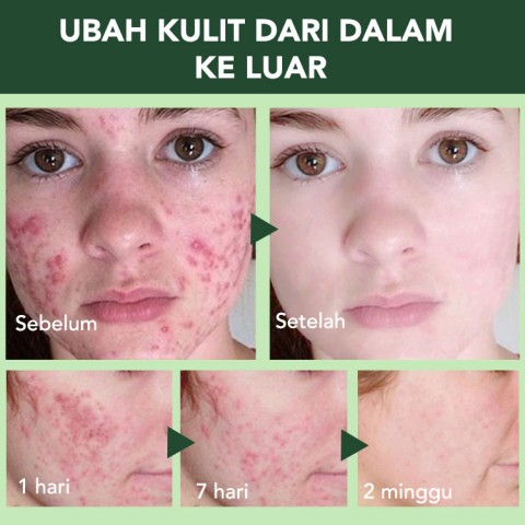 Krim jerawat kontrol minyak herbal asam salisilat