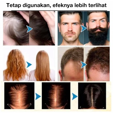 Minyak Esensial Pertumbuhan Rambut Rosemary Alami