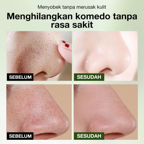 Masker hidung penghilang komedo