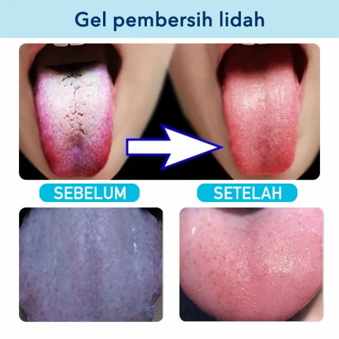 Gel Pembersih Lidah Dengan Kuas - Mengurangi Bau Nafas, Kuas Kebersihan Mulut yang Sehat - Untuk Dewasa dan Anak-anak