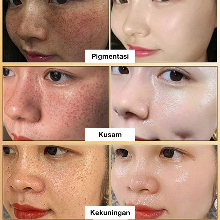 Promosi Idul Adha-Potongan kedua hanya 70 rb - Esensi pencerah spot - Ucapkan selamat tinggal pada semua bintik-bintik, bintik hitam, dan bintik matahari!	