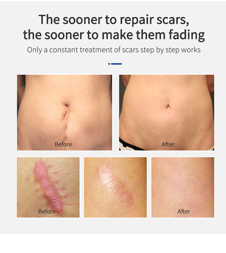 Shark Scar Treatment Gel